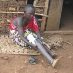 Frau, die an Lepra leidet