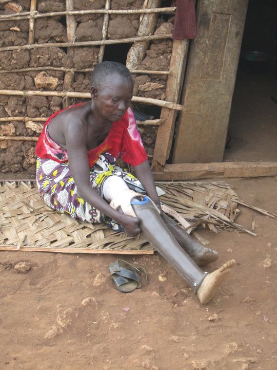 Frau, die an Lepra leidet